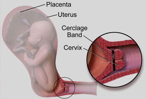 هل يؤثر تطويق أو ربط عنق الرحم على حماية جنيني من الإجهاض ؟!