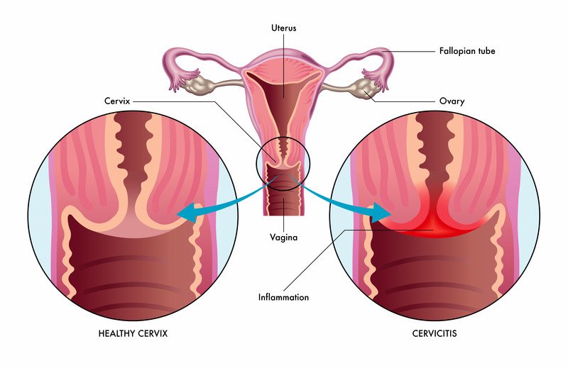 التهاب عنق الرحم هل يمنع الحمل أو يضره إن حدث