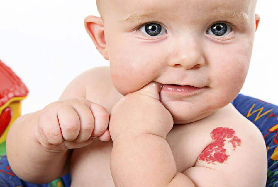 الوحمات الدموية لدى الرضع: هل هي سبب للقلق أم مجرد ظاهرة عابرة؟