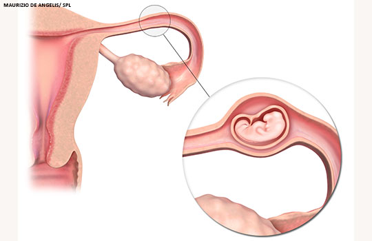 اكتشفي الفرق بين علامات الحمل خارج الرحم والحمل الطبيعي 