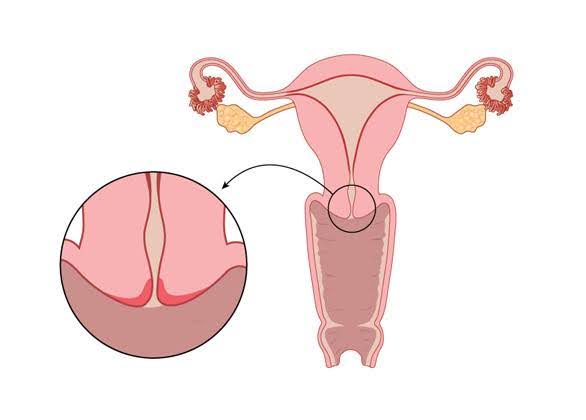 ما هي أعراض التهاب عنق الرحم؟ وهل يؤخر الحمل؟