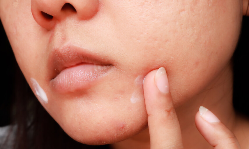 5 علاجات منزلية للتخلص من الرؤوس البيضاء في بشرتك !         