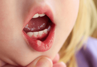 أفضل 11 علاجًا منزليًا لقرحة الفم عند الرضع والأطفال الصغار
