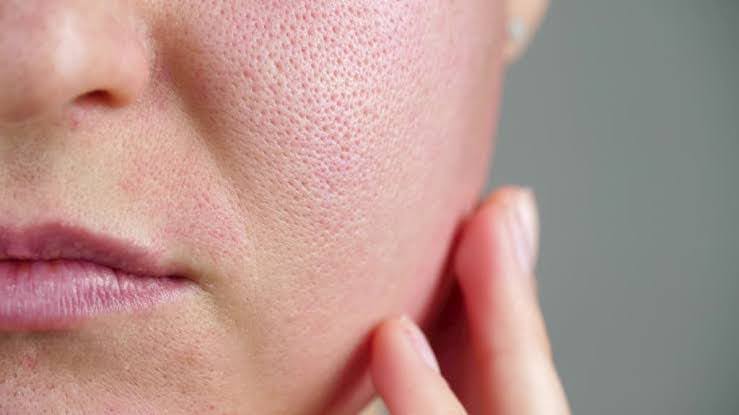 أصعب مشاكل البشرة! إليكِ كيف تتخلصي منها نهائيًا 