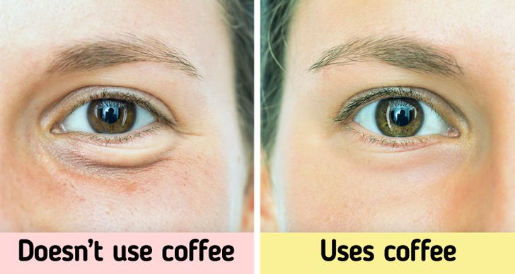 8 نصائح لتقليل الهالات السوداء والتعب تحت العيون !          